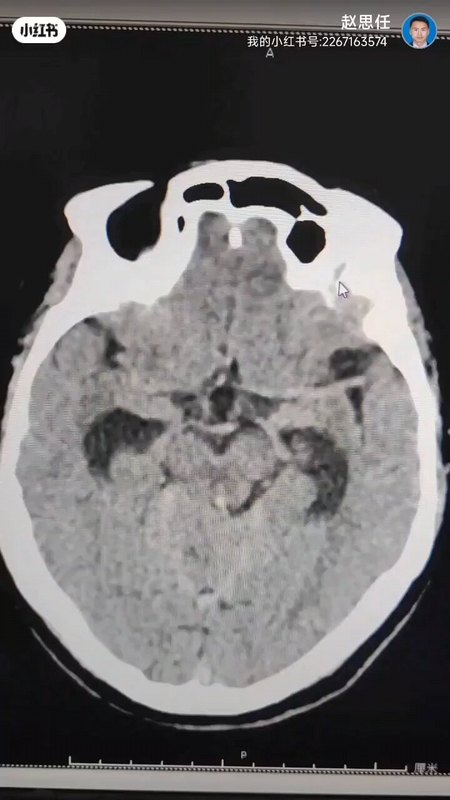 脑内出血之小脑出血