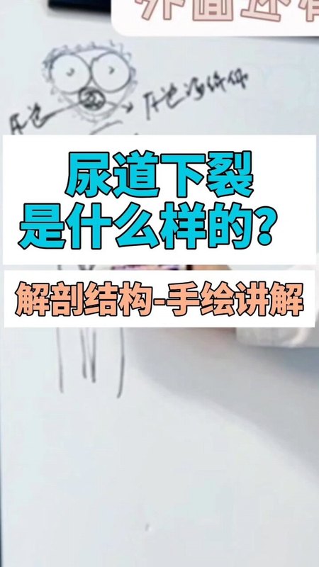 手绘解剖尿道下裂的结构畸形