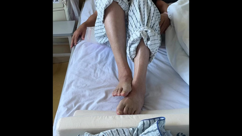 脊髓损伤后痉挛性瘫痪3年显微外科技术下的周围神经缩窄术术前术后视频对比