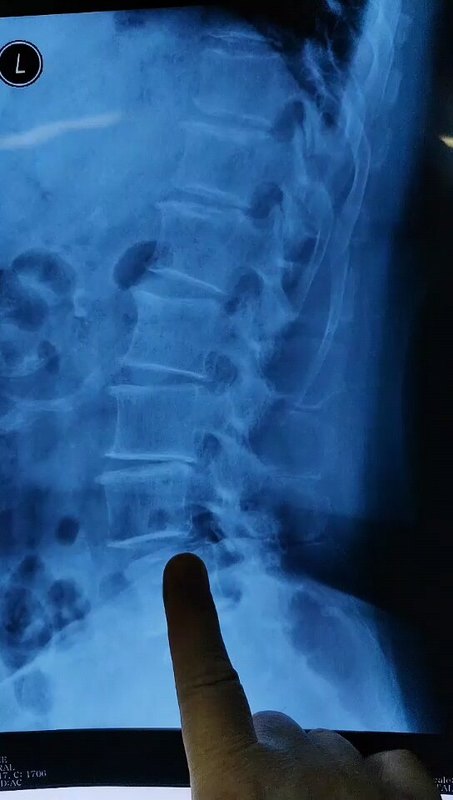 73岁腰椎滑脱腰椎管狭窄，微创手术