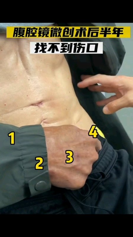 腹腔镜微创手术