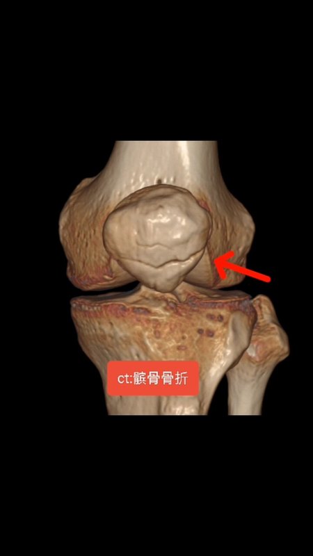 ［骨折］科普第25集:髌骨骨折保守治疗效果如何？