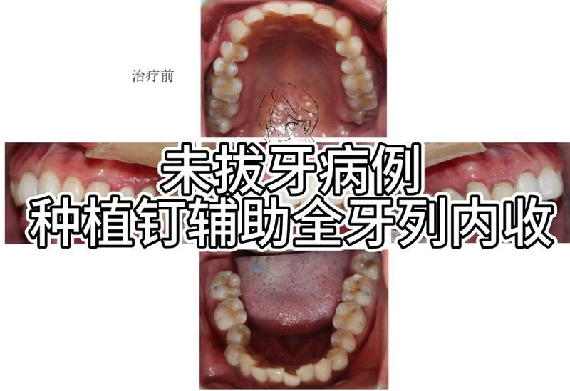 未拔牙拥挤病例
