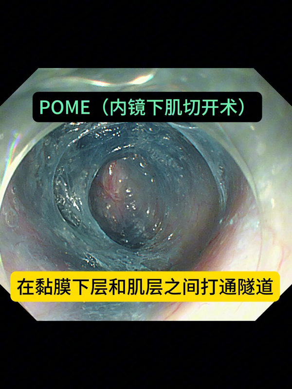 贲门失弛缓内镜微创治疗
