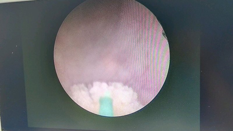 输尿管镜激光碎石是怎么做的？