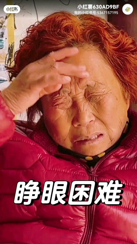 梅杰综合征眼睑痉挛