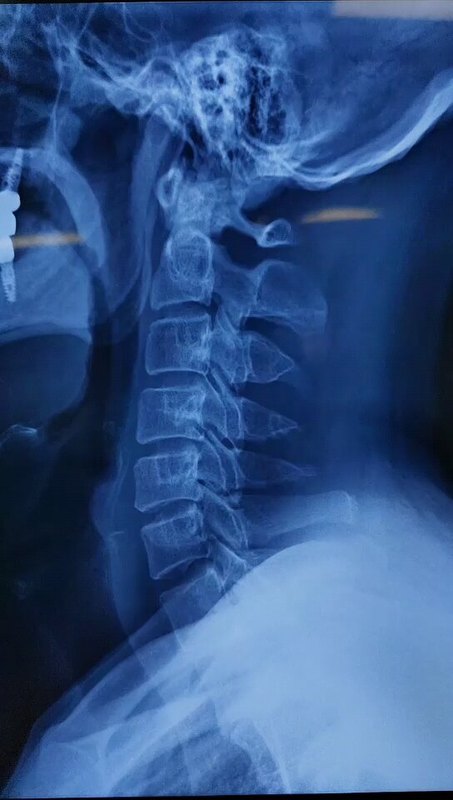 53岁双间隙脊髓型颈椎病，微创手术