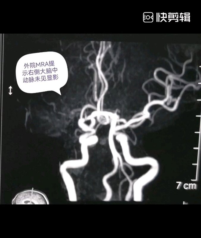 脑血管搭桥治疗出血型的烟雾病，桥血管越来越粗