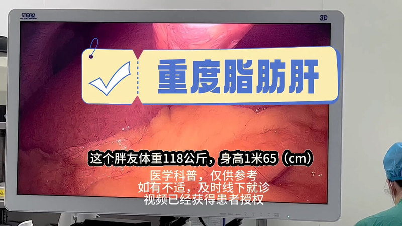 重度脂肪肝