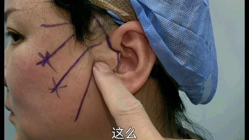小拉皮切口设计