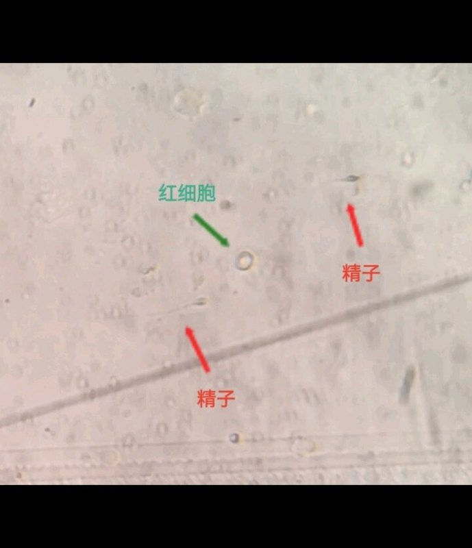 特发性无精子症，取卵同期显微取精