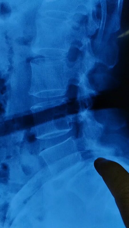 58岁腰椎滑脱椎管狭窄，微创手术