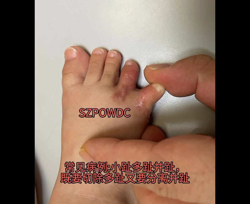 小趾多趾并趾  不仅要切除多趾能，还需要分离并趾