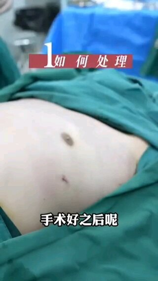上海九院何金光男乳微创术后注意事项视频版