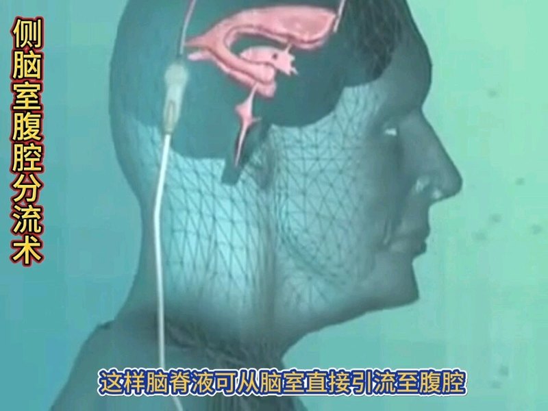 侧脑室腹腔分流术治疗脑积水3D演示