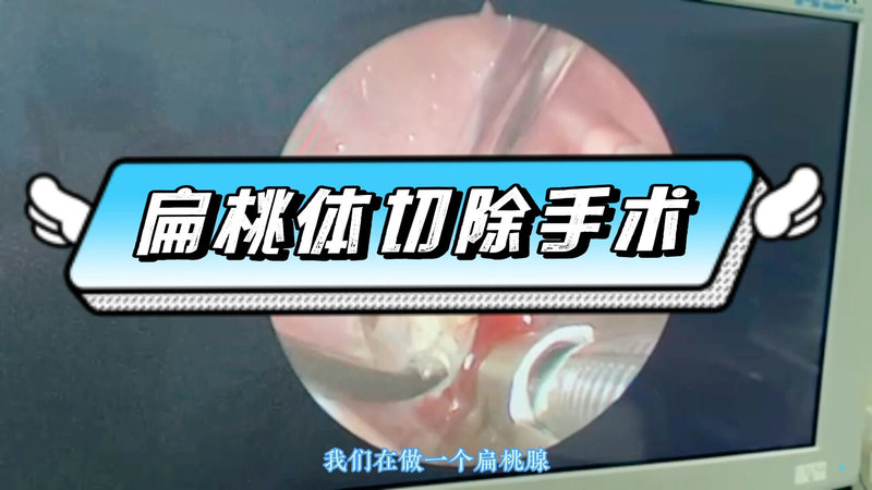 低温等离子技术扁桃体切除术