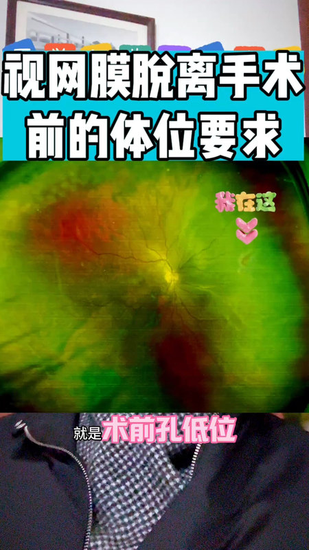 视网膜脱离手术前的体位要求