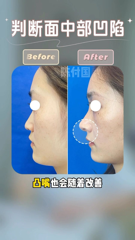 陈付国博士：如何改善面中部凹陷??
