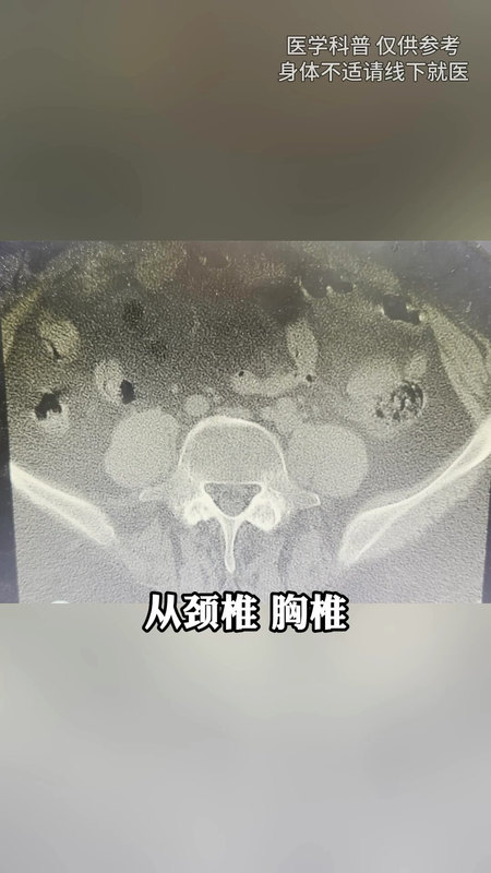 26岁未曾治疗，但已经中晚期的强直性脊柱炎