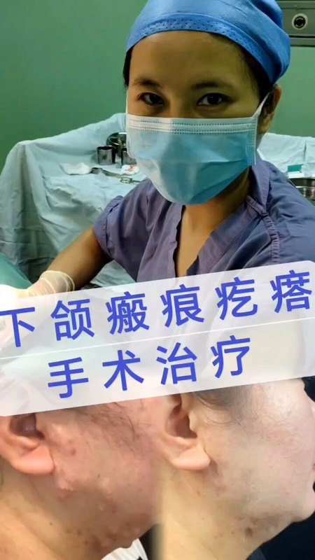 下颌瘢痕疙瘩的联合治疗