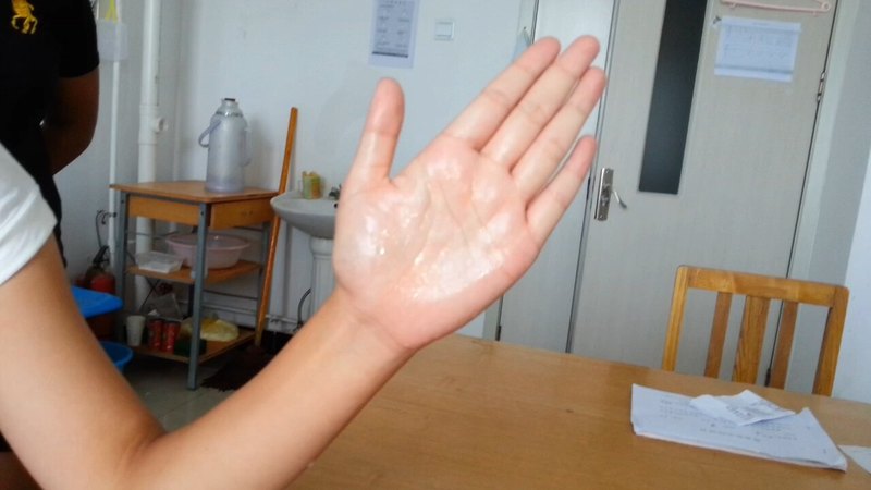 手掌多汗成雨滴下