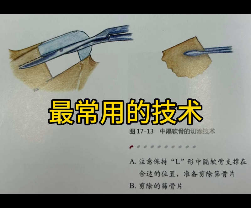 歪鼻科普。