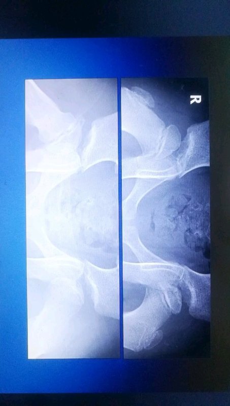 儿童股骨头坏死（perthes病）早期就诊原因