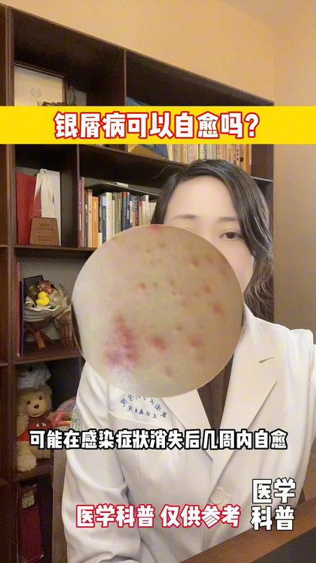 银屑病可以自愈吗？