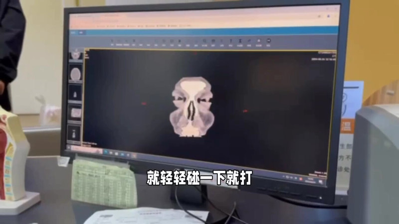 鼻中隔矫正，回归健康