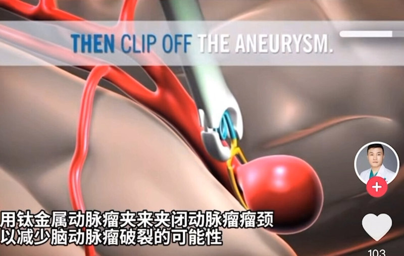 脑动脉瘤三种治疗方式：开颅夹闭，弹簧圈栓塞，密网支架植入