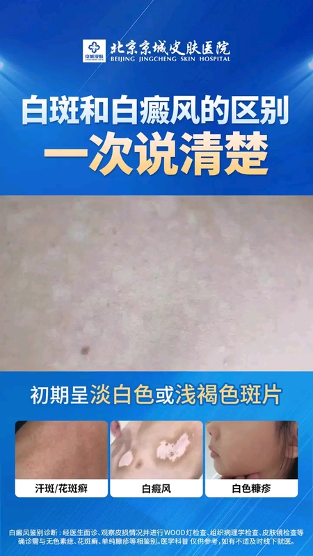 白斑和白癜风的区别