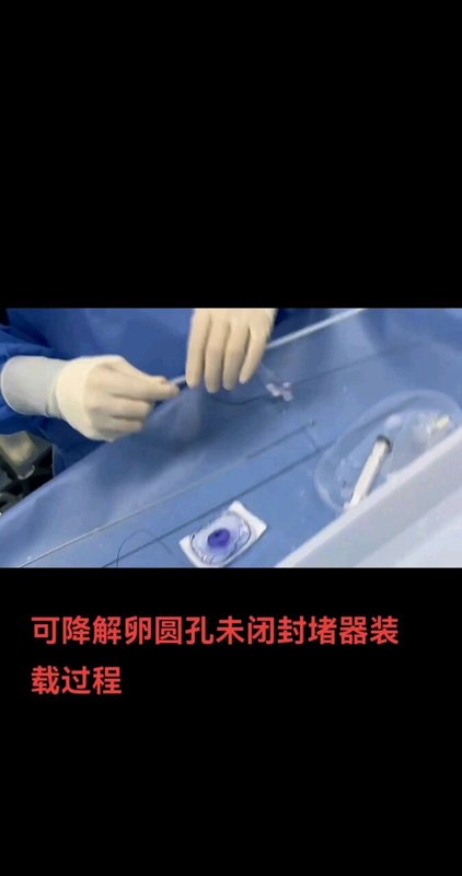 可降解卵圆孔未闭封堵器