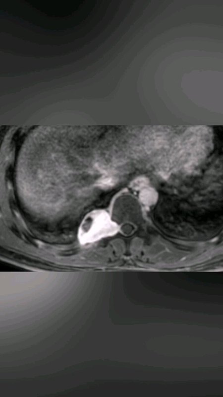 患者背部疼痛，就诊发现椎旁巨大神经鞘瘤，完全切除肿瘤…症状缓解