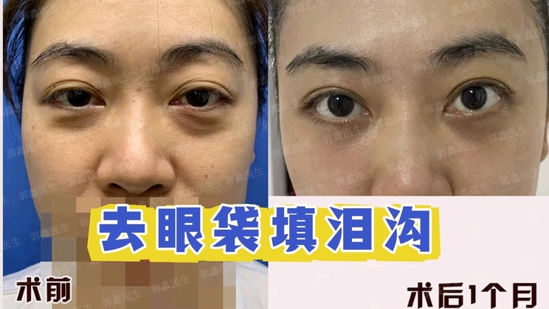 眼袋大小不一样，去眼袋后会怎样？