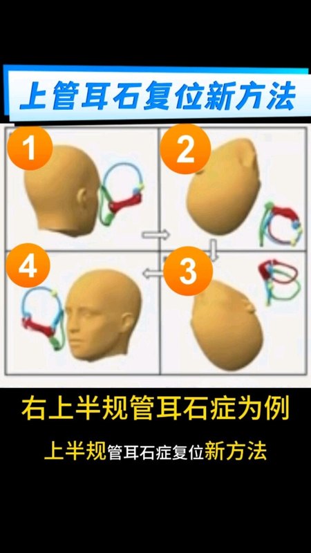 上半规管耳石症复位新方法