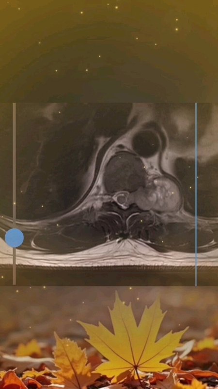 胸椎神经鞘瘤是一种良性肿瘤，生长缓慢，但有些神经鞘瘤可以长得很大，压迫脊髓产生神经症状，表现为下肢行