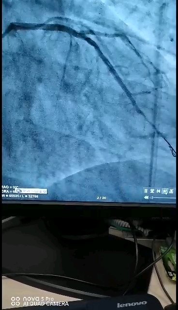 支架怎么放的？即刻解除狭窄，恢复正常血流