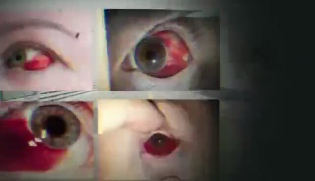 眼睛突然一片血红是怎么回事？