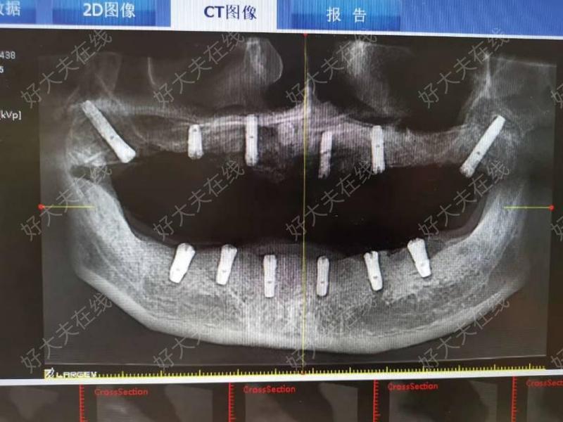 北京大學口腔醫院CT加急-北京大學口腔醫院ct加急核酸 