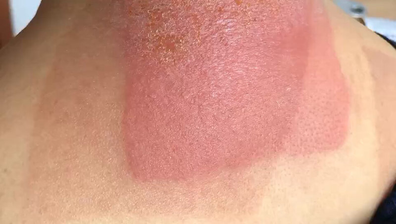 接触性皮炎