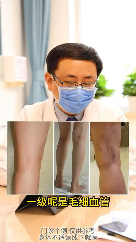 下肢静脉曲张能不能不做手术？