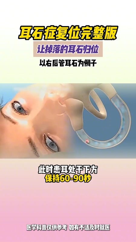 耳石症复位