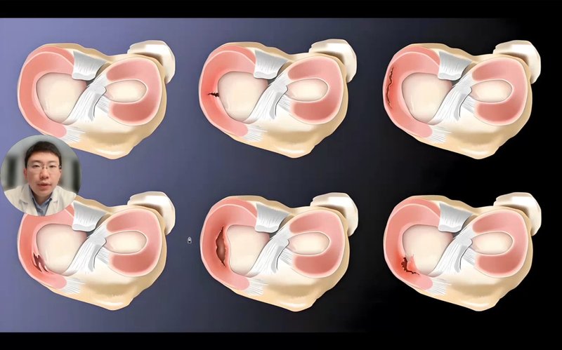 半月板哪些情况要切掉，哪些能缝补回来？