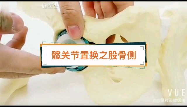 人工髋关节置换股骨侧的假体是怎么安装？