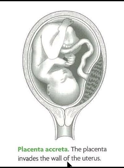 一图读懂胎盘植入为何特别危险？