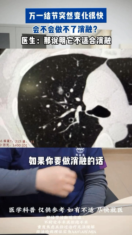 磨玻璃结节都能消融吗？
                            我的理念一直是磨玻璃结节患者是求稳妥求根治