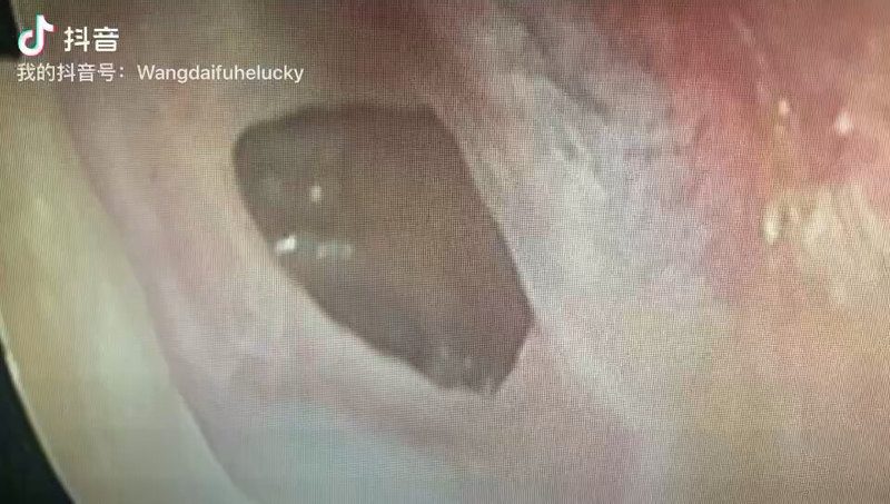 鼓膜修补的重要性