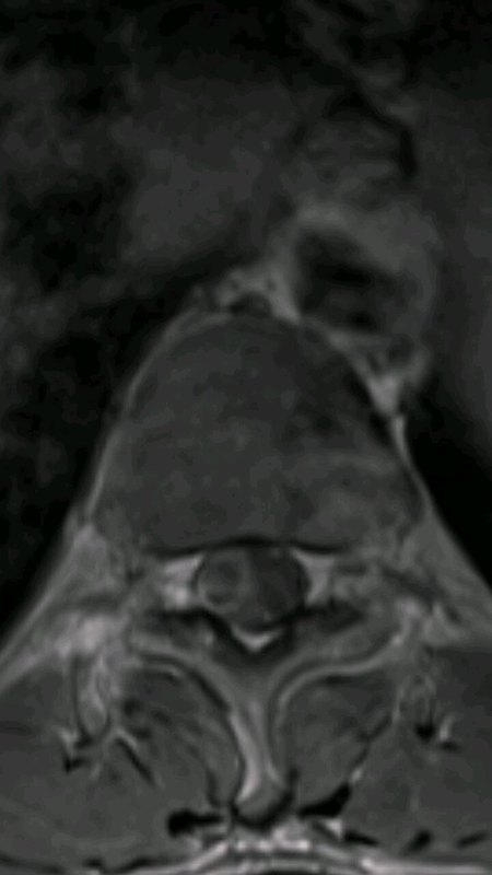 多发神经鞘瘤：中年男性，下肢乏力伴麻木入院，切除肿瘤后，肢体乏力及麻木症状消失…