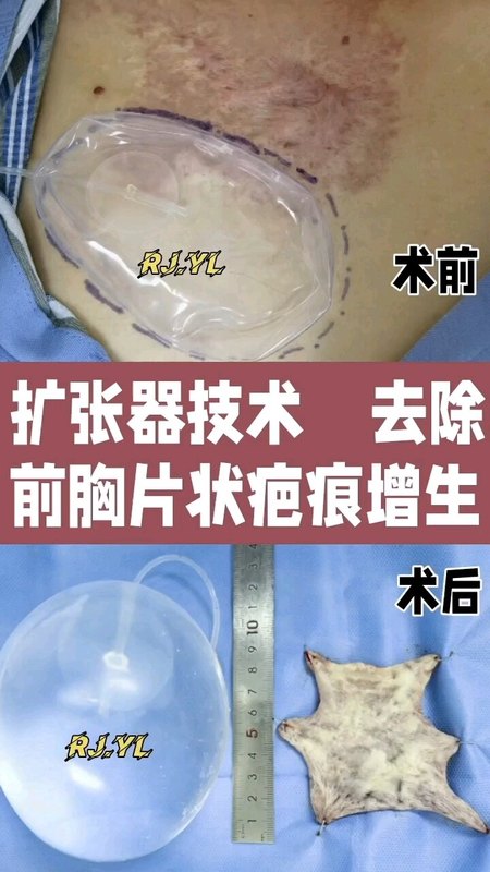 前胸大片鲜红斑痣疤痕增生的去除，扩张器手术祛疤