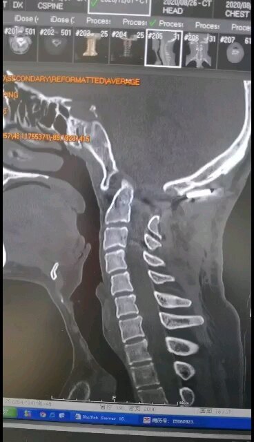 颈椎手术钉板脱了怎么办？